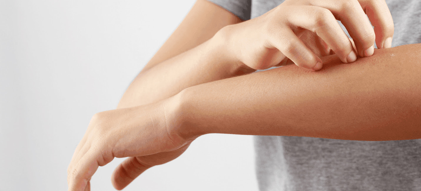 Gerindo a Dermatite Atópica: Estratégias Eficazes de Tratamento